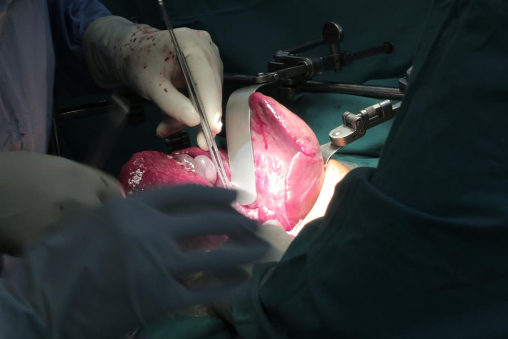 Open Heart Surgery at VSH Hospital
