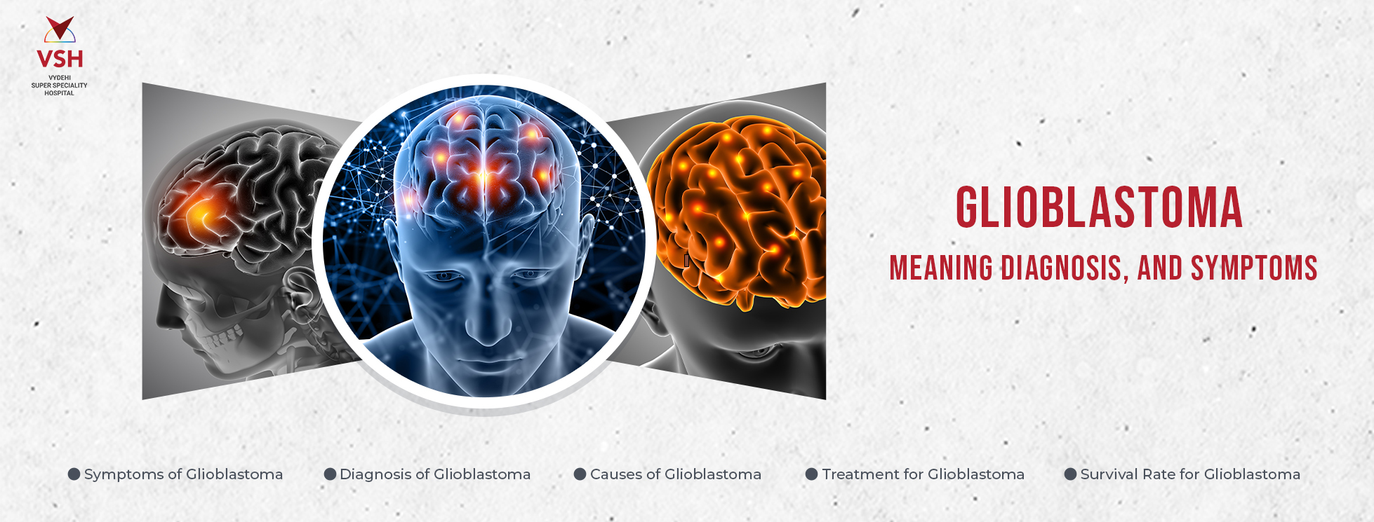 Glioblastoma Meaning, Diagnosis, and Symptoms