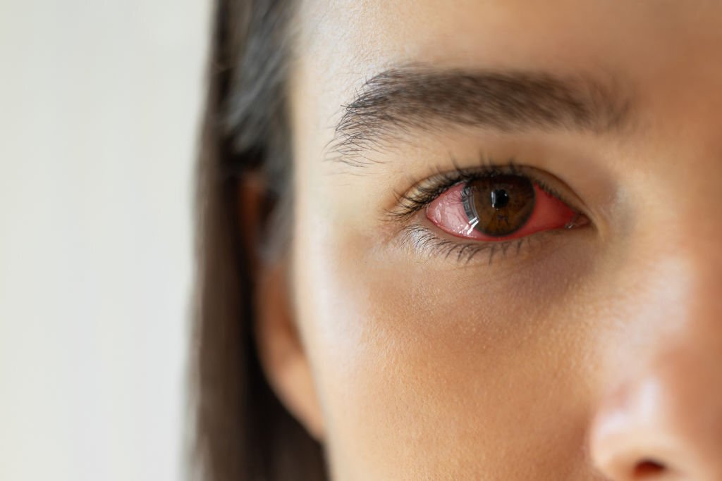 Eye Flu (Conjunctivitis) Treatment: Understanding Symptoms and Home Remedies