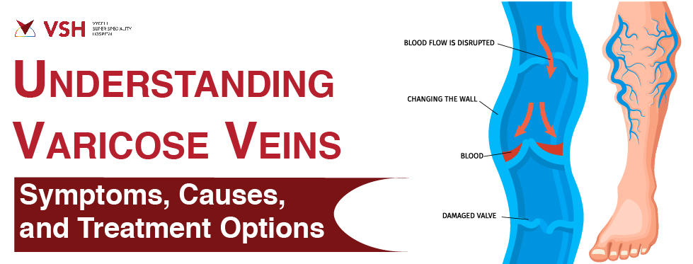 Varicose Veins - Symptoms, Causes and Treatment
