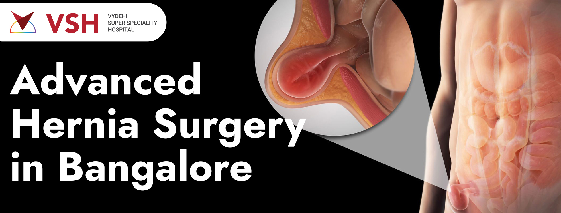 Hernia Surgery Doctors in Bangalore