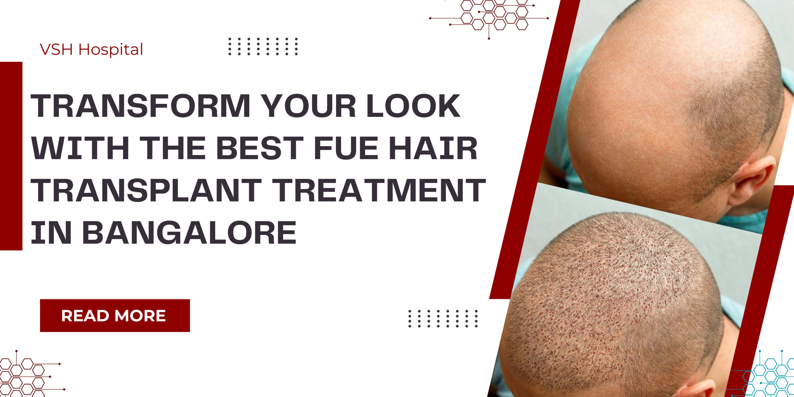 Best FUE Hair Transplant Treatment in Bangalore
