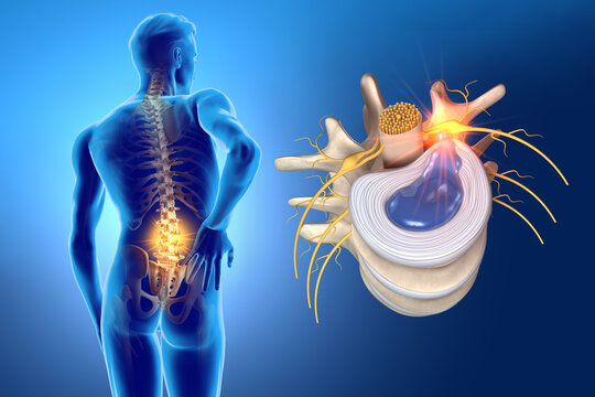 A person holding their lower back in pain with radiating pain extending down the leg, a common symptom of a slip disc.